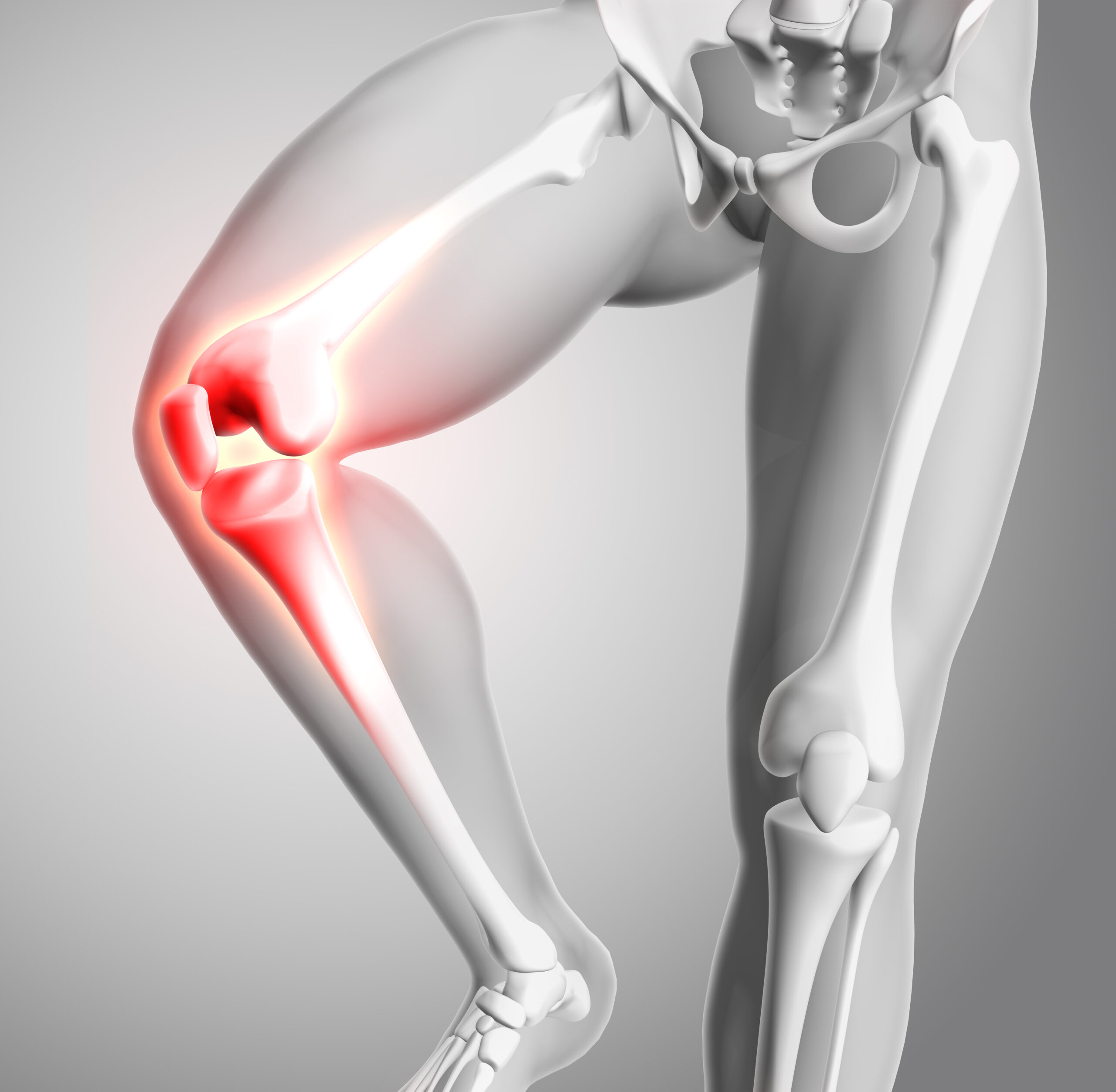 Artrosis de rodilla: tratamiento en fisioterapia - Fisioterapia Sevilla